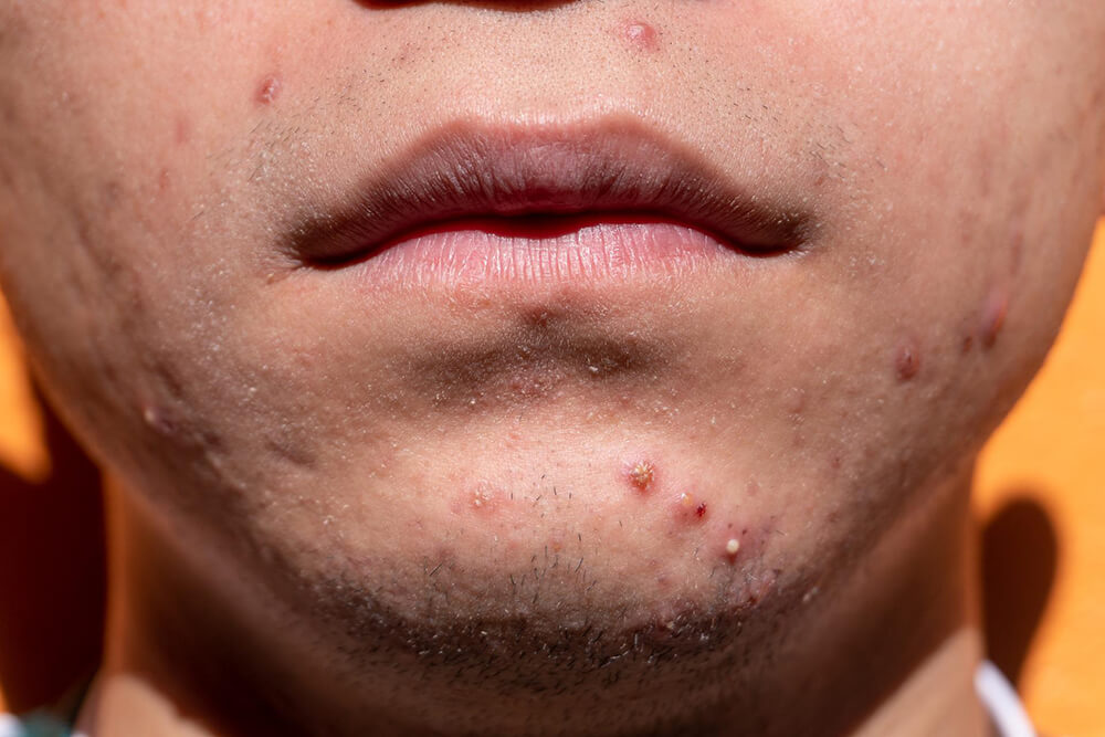 Acne in Teenagers